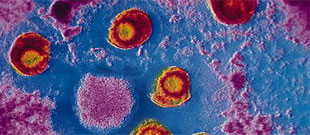 CMV - Cytomégalovirus CMV - Cytomégalovirus